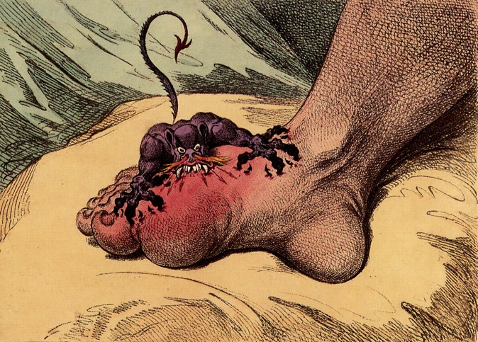 The Gout - An Illustration by James Gillray